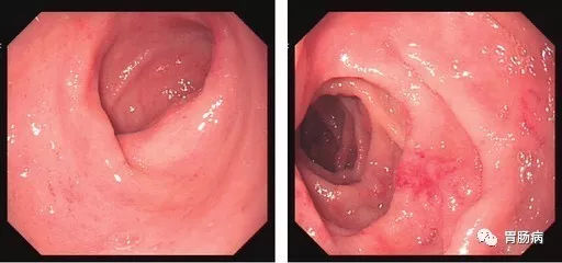 萎縮性胃炎不可怕，只要真正了解它