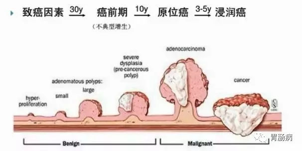 體檢查出腸息肉一定要切除！ 95%腸癌由它演變而來