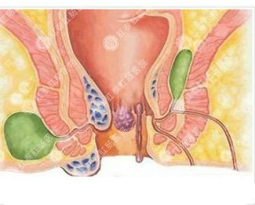 南寧哪個(gè)醫(yī)院可以做肛周膿腫？